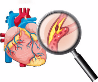 hs-CRP กับ โรคหลอดเลือดหัวใจตีบ